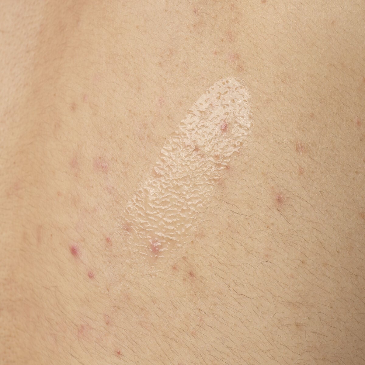 salicylic-acid-0-5-body-serum-y6 ORD-salicylic-acid-05-body-240ml-application.jpg