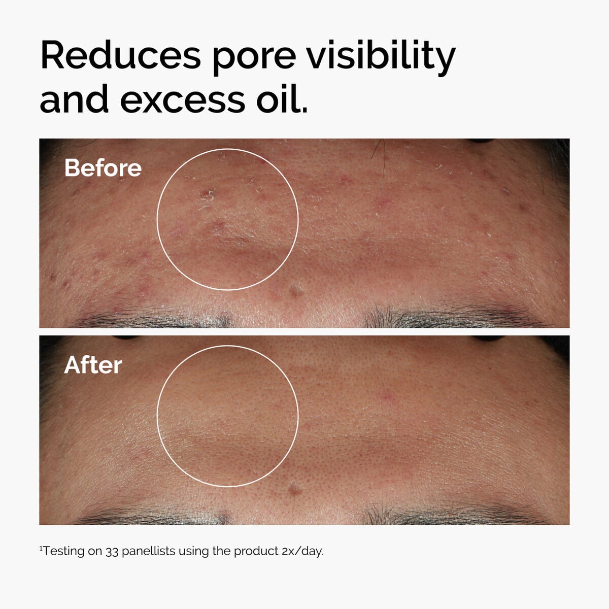 niacinamide-10-zinc-1-a4 ord-niacinamide-zinc-blemish-serum-before-after-pores.jpg