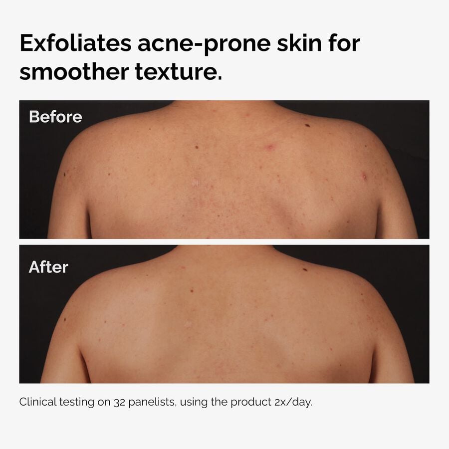 the-body-care-collection-y7 ord-salicylic-acid-body-serum-before-after-graphic-NA.jpg