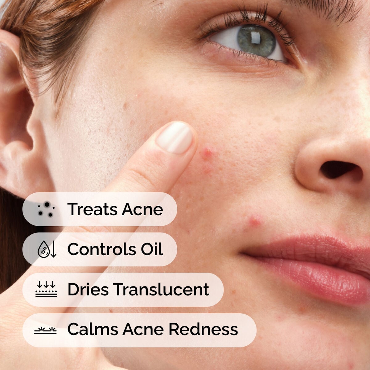 sulfur-10-powder-to-cream-concentrate-n7 ord-sulfur-10pct-powder-to-cream-concentrate-model-application-with-benefits-acne.jpg